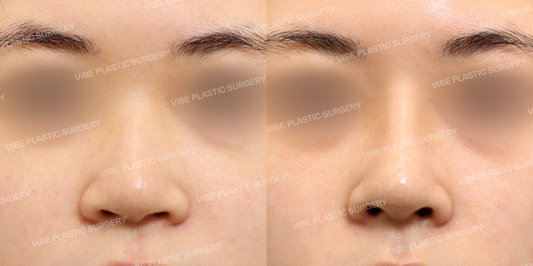 #콧대 #코끝 #매부리코 #복코