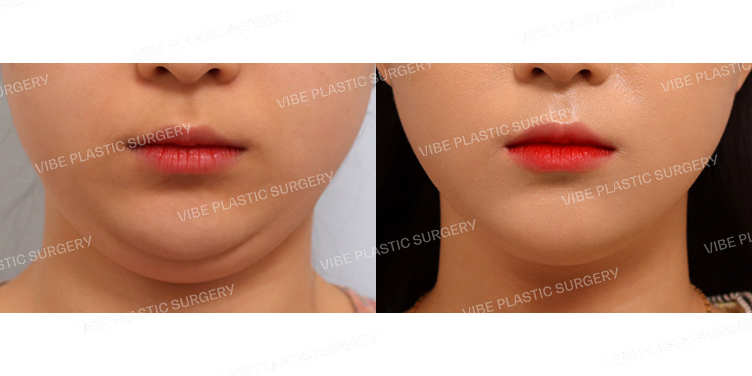 #초음파지방흡입(이중턱,턱라인)