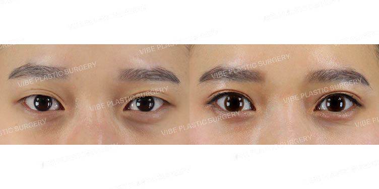 #자연유착 #눈밑지방재배치