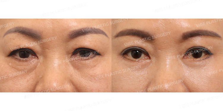 #눈썹밑거상 #하안검