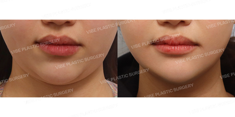 #초음파지방흡입(이중턱,턱라인)