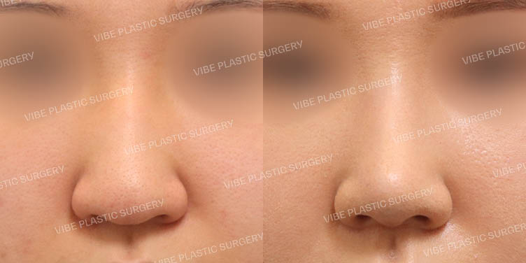 #무보형물 #매부리코 #긴코 #복코