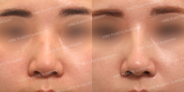 #복코 #매부리코