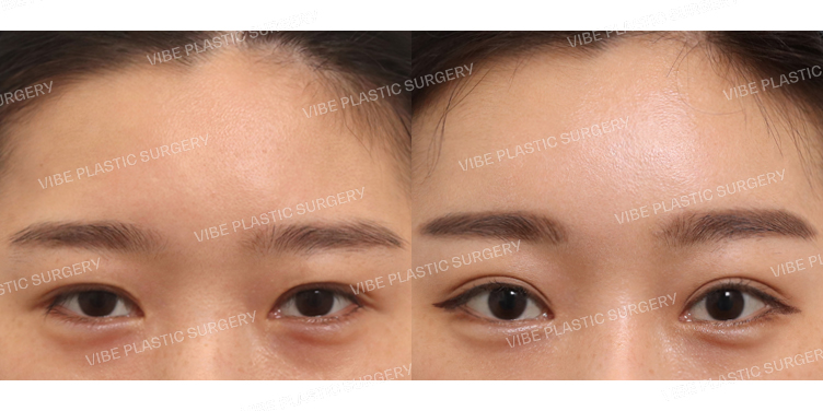 #절개눈매교정(재수술) #내시경이마거상