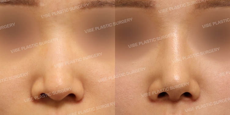 #낮은코 #매부리코