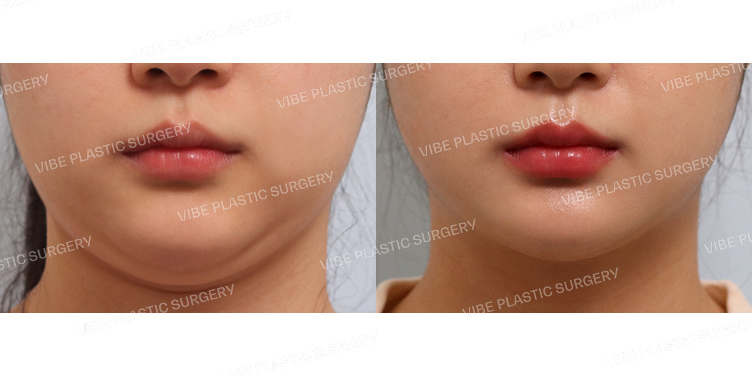 #초음파지방흡입(이중턱,턱라인)