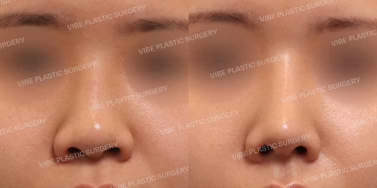 #매부리코 #복코 #비순각교정 #휜코 #필러녹이기 #이물질제거