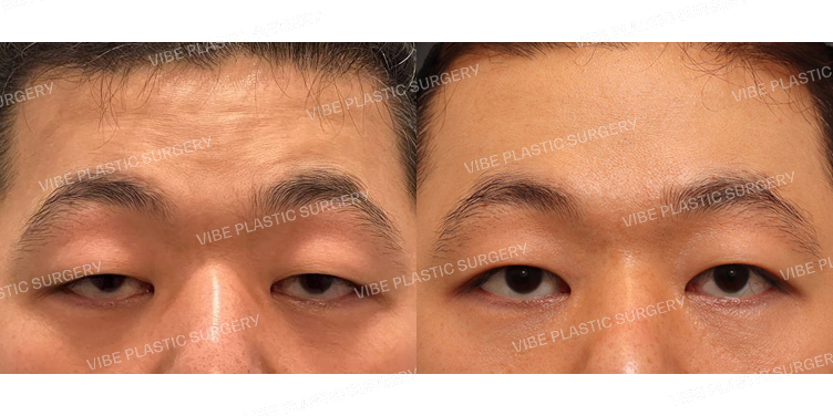 #절개눈매교정 #내시경이마거상