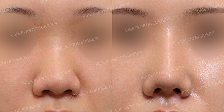 #낮은코 #복코 #비순각교정 #절골