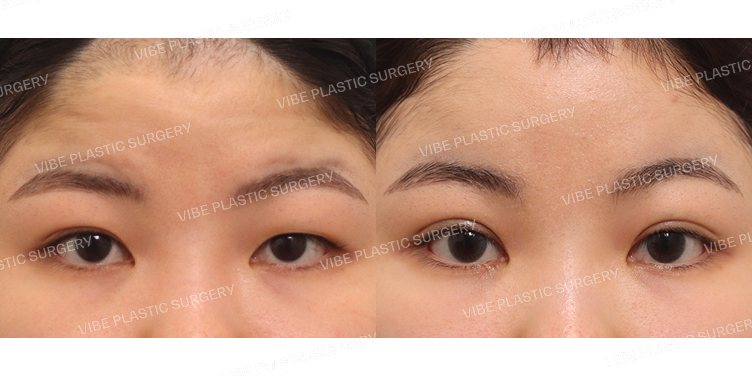 #부분절개눈매교정 #내시경이마거상