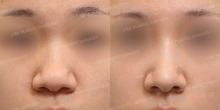 #복코 #매부리코 #융비술 #절골