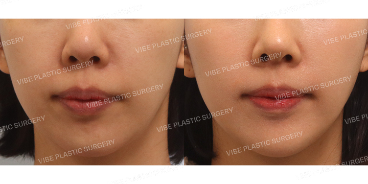 #풀페이스지방이식