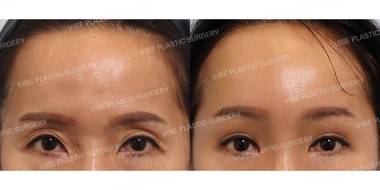 #내시경이마거상 #눈두덩이지방이식