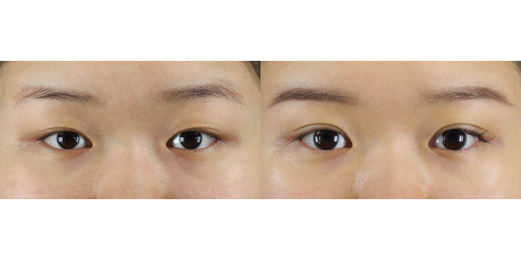 #부분절개눈매교정