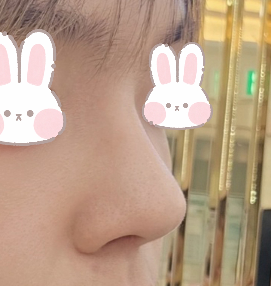 코수술 유영문원장님께 받은지 3달차!