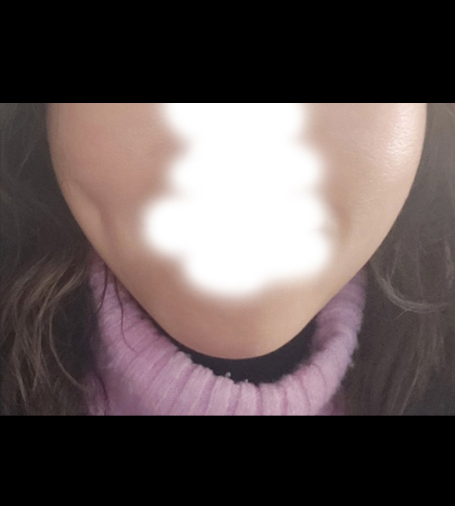 보조개+심부볼제거 후기