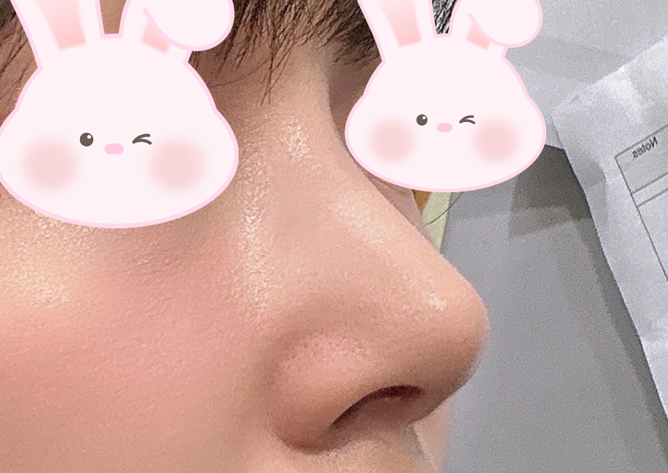 바이브 단연코로 코수술해써용