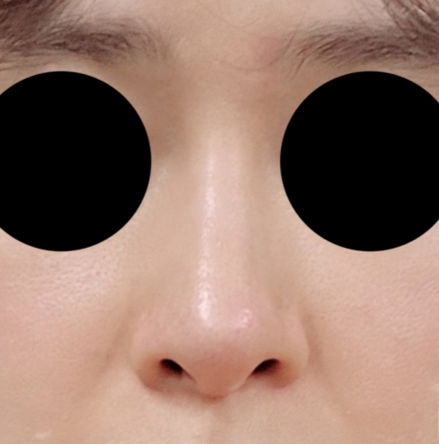 무보형물 자가늑 코수술 반년차~