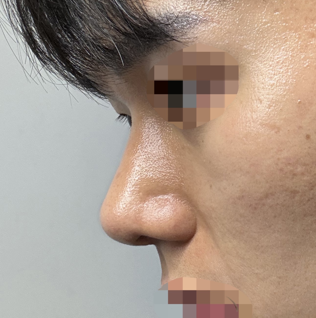 무보형물 2개월 지났네요