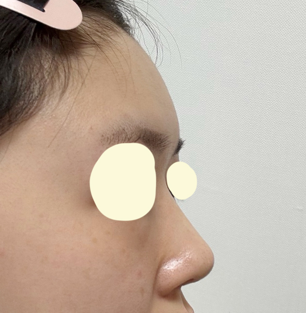 코, 지방이식 후기입니다~