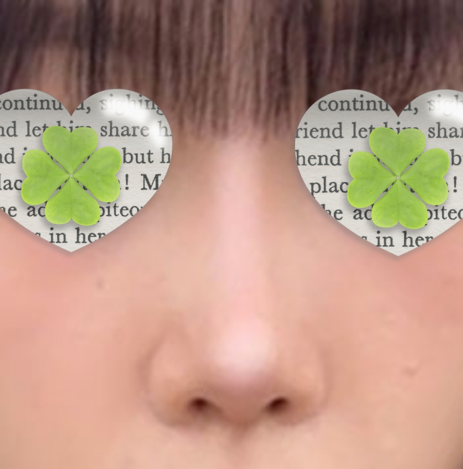 자가늑연골 코재수술 세달차ㅎ0ㅎ