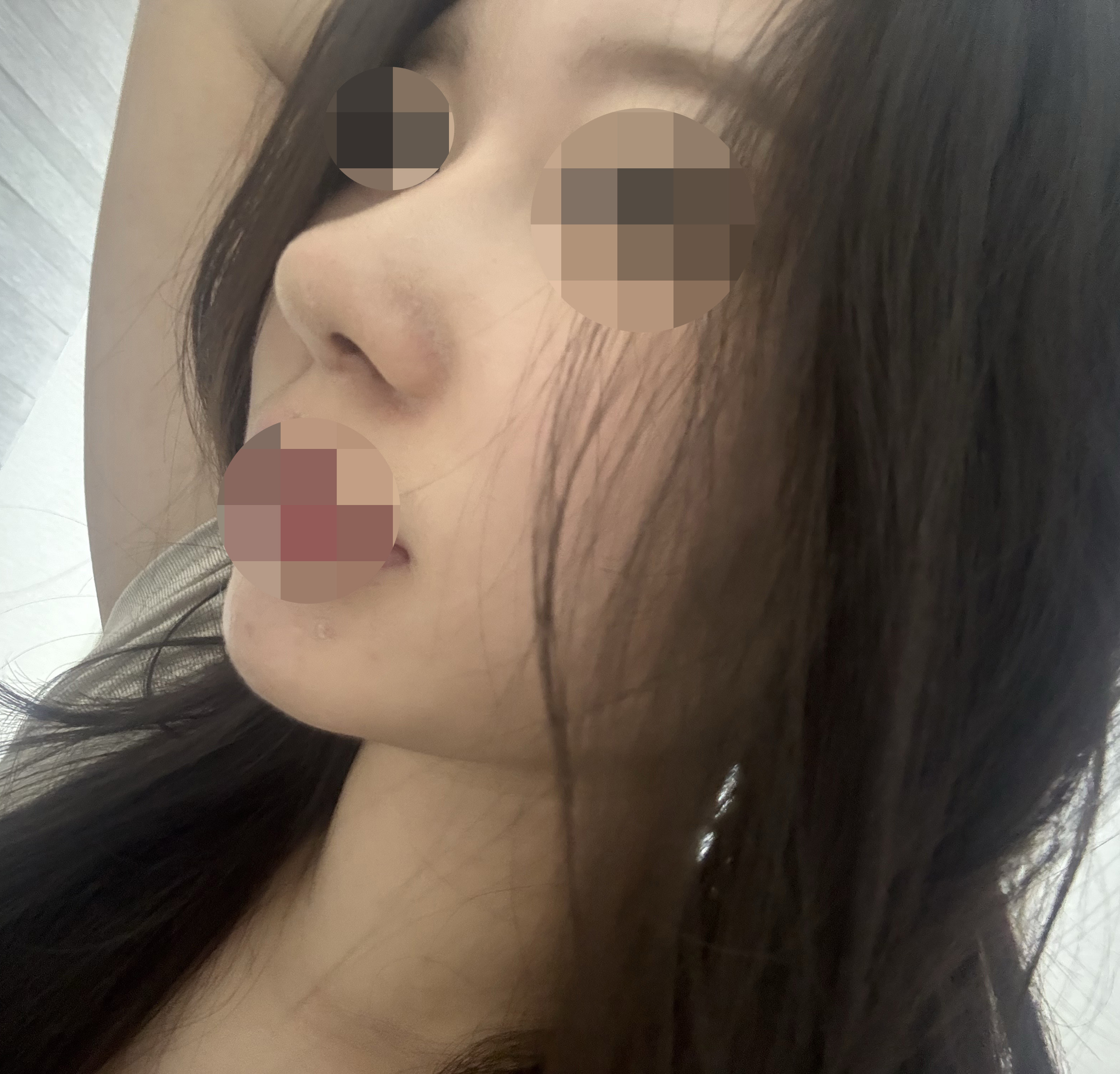 자려한라인으로 수술잘해주셨어요