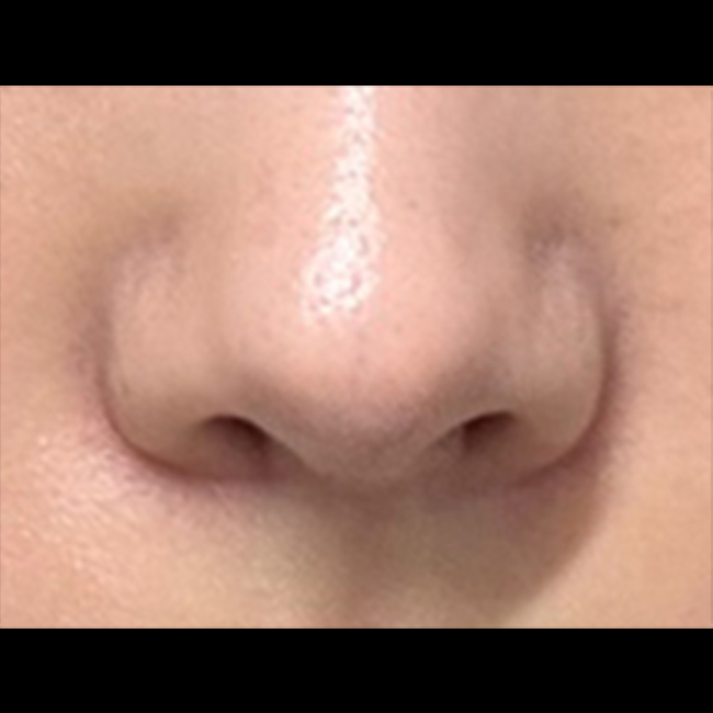 비공내리기 재수술 잘한거 같아요