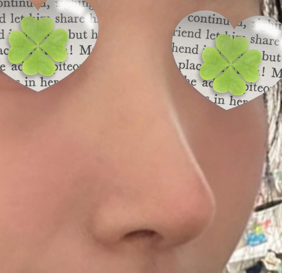 무보형물 코수술 다섯달차 후깅