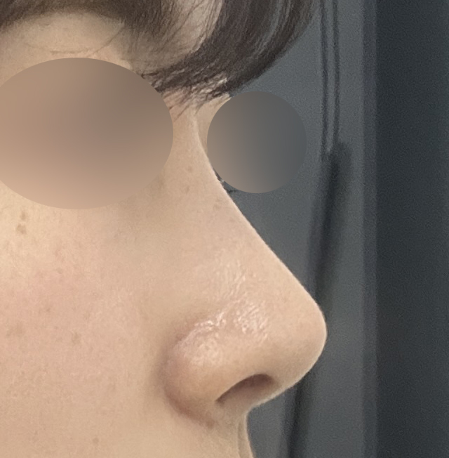 무보형물 코끝성형 3주차!!!