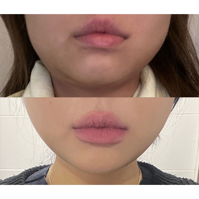 바이브 완죤 얼굴지방흡입맛집 ㅎㅎ