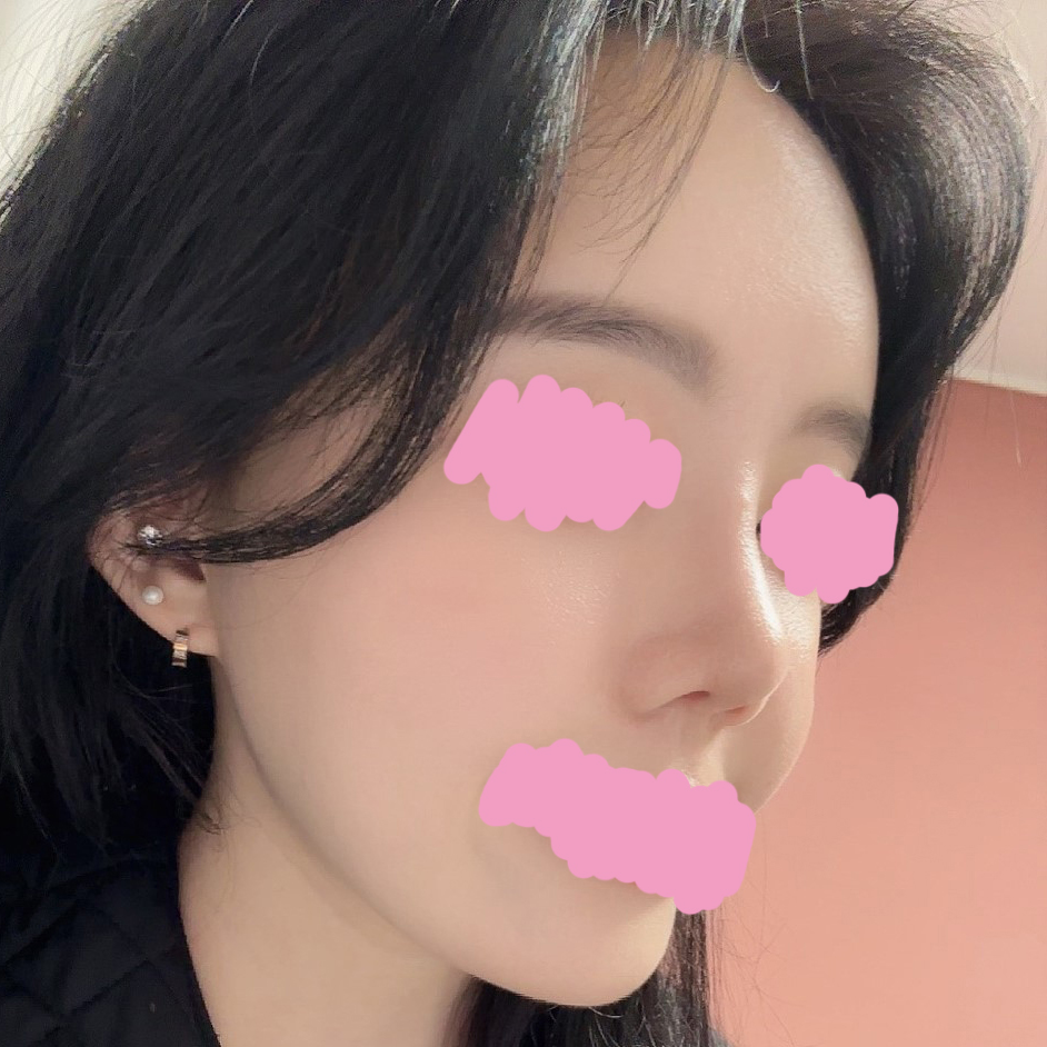 코, 지방이식 의버지ㅠㅜ