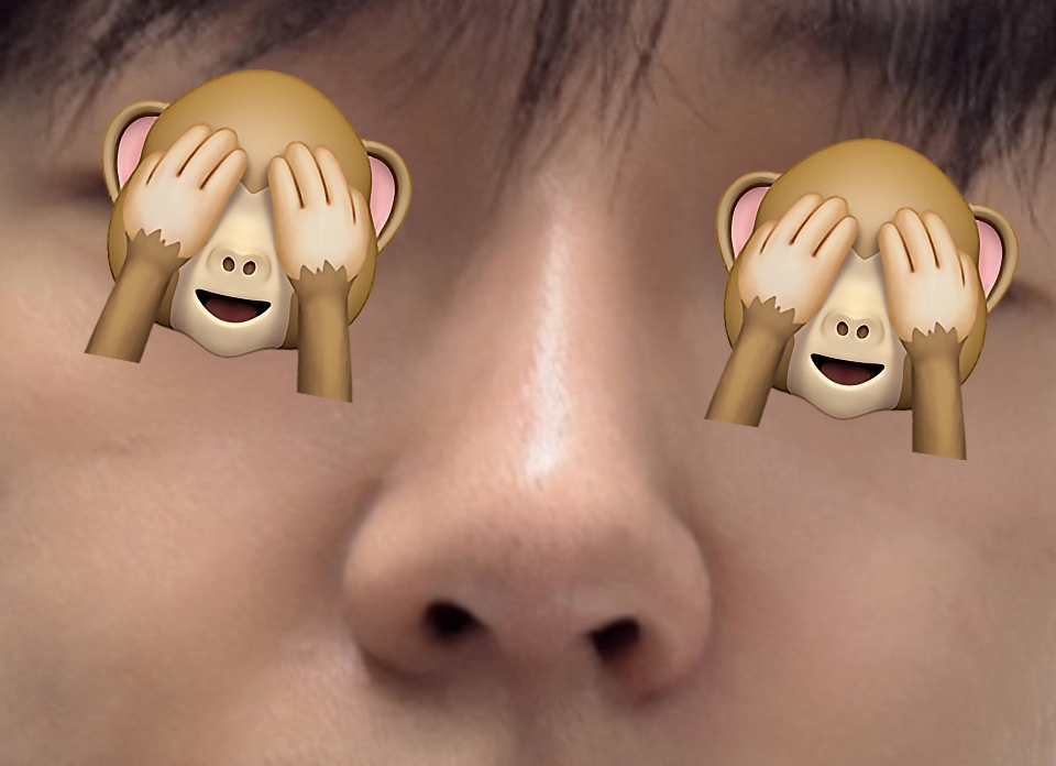 낮은 복코, 매부리코 개선한 후기