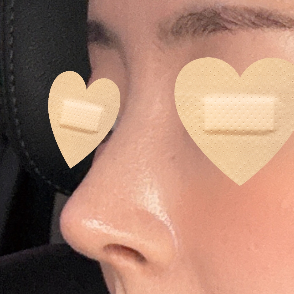 코성형 잘한선택입니다 ~!