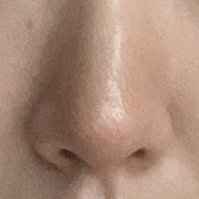 수술 후 용코 개선이 많이 됐어요 ! 감사합니다