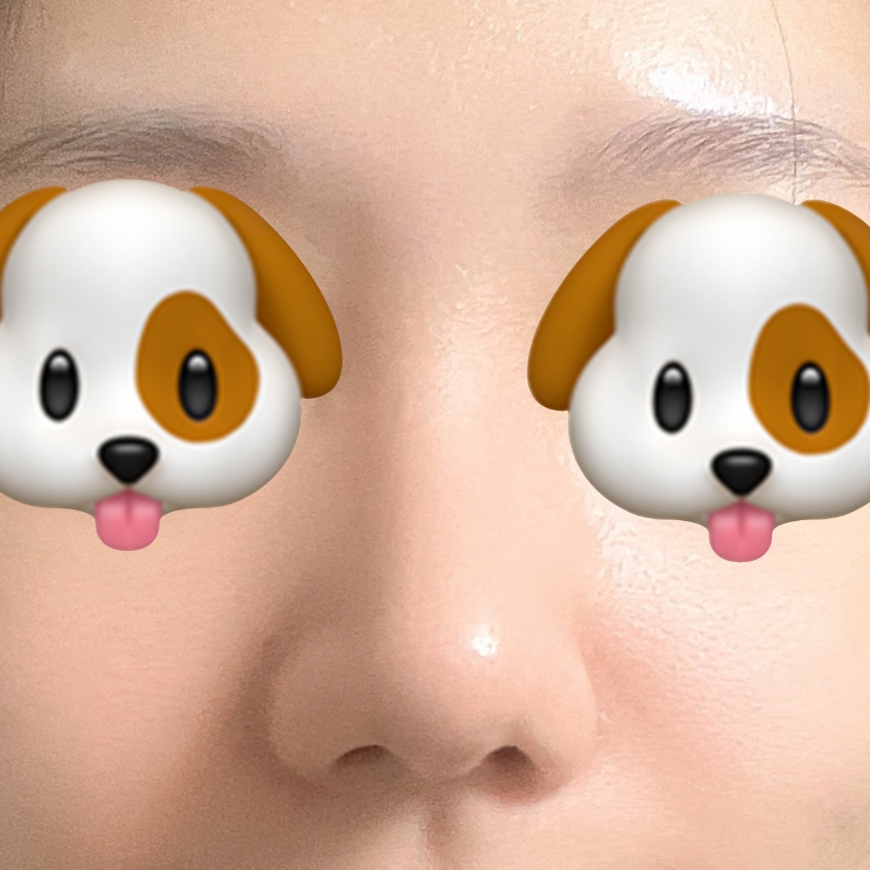 무보형물 코수술, 눈성형 후기입니다!