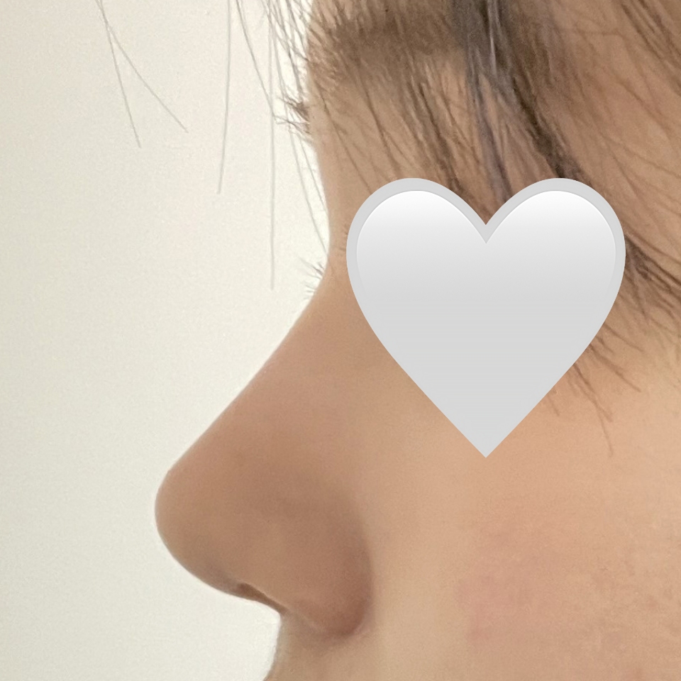 코성형 만족스러워요 ~ 감사합니다 !