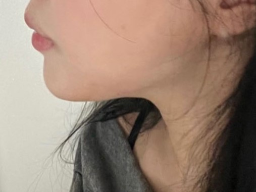 얼굴지방흡입 바이브 추천 합니다 !!!!