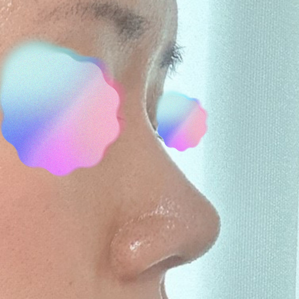 코수술한지 1개월차 됐습니다 !