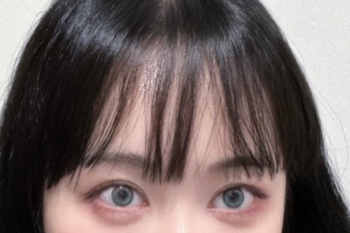 눈 재수술, 이중턱지방흡입 6개월차 됐어용 ~!