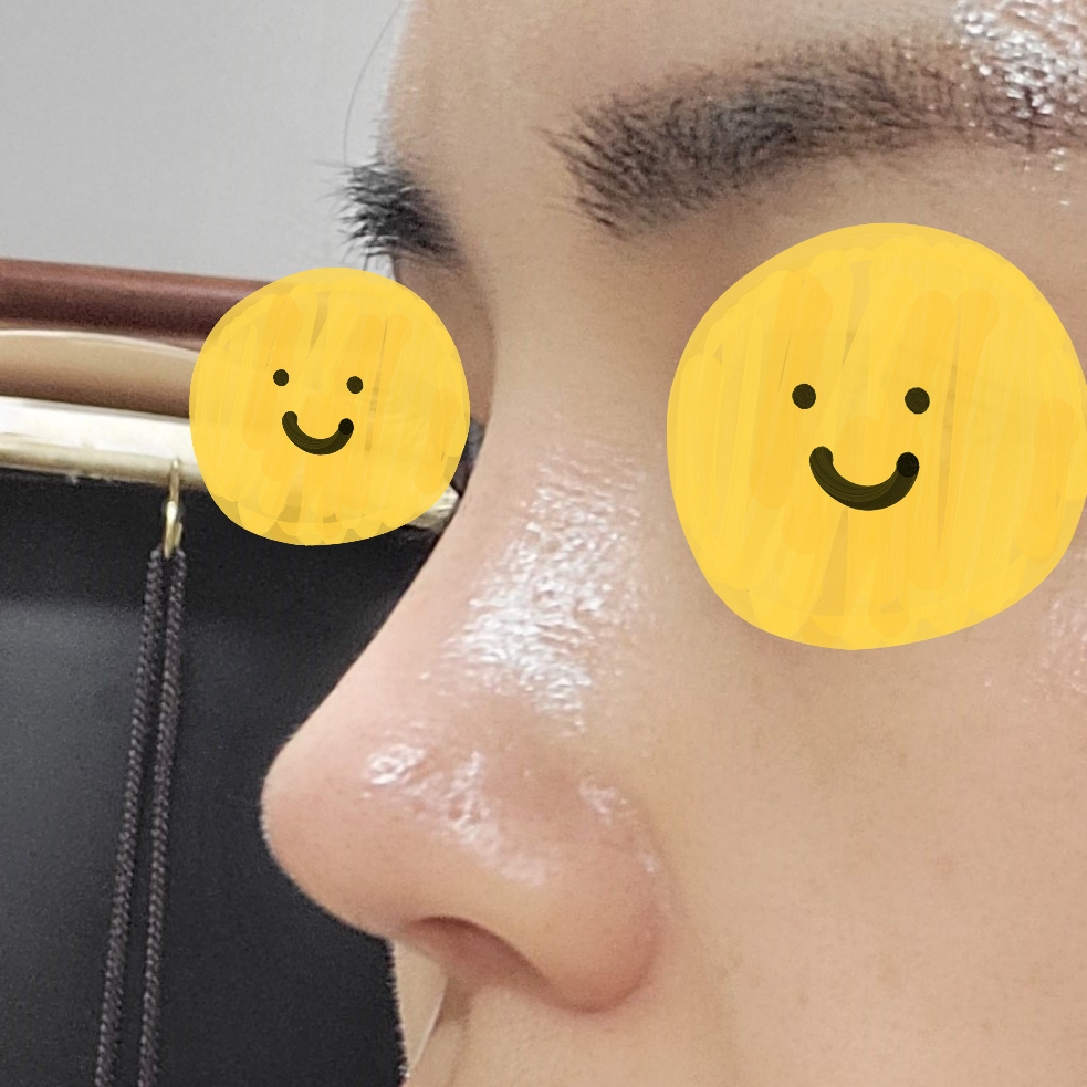 코수술 후 예뻐졌다는 말을 많이 들어요