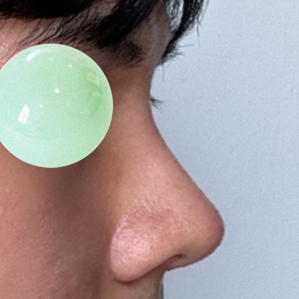 코수술 후회 없습니다 !