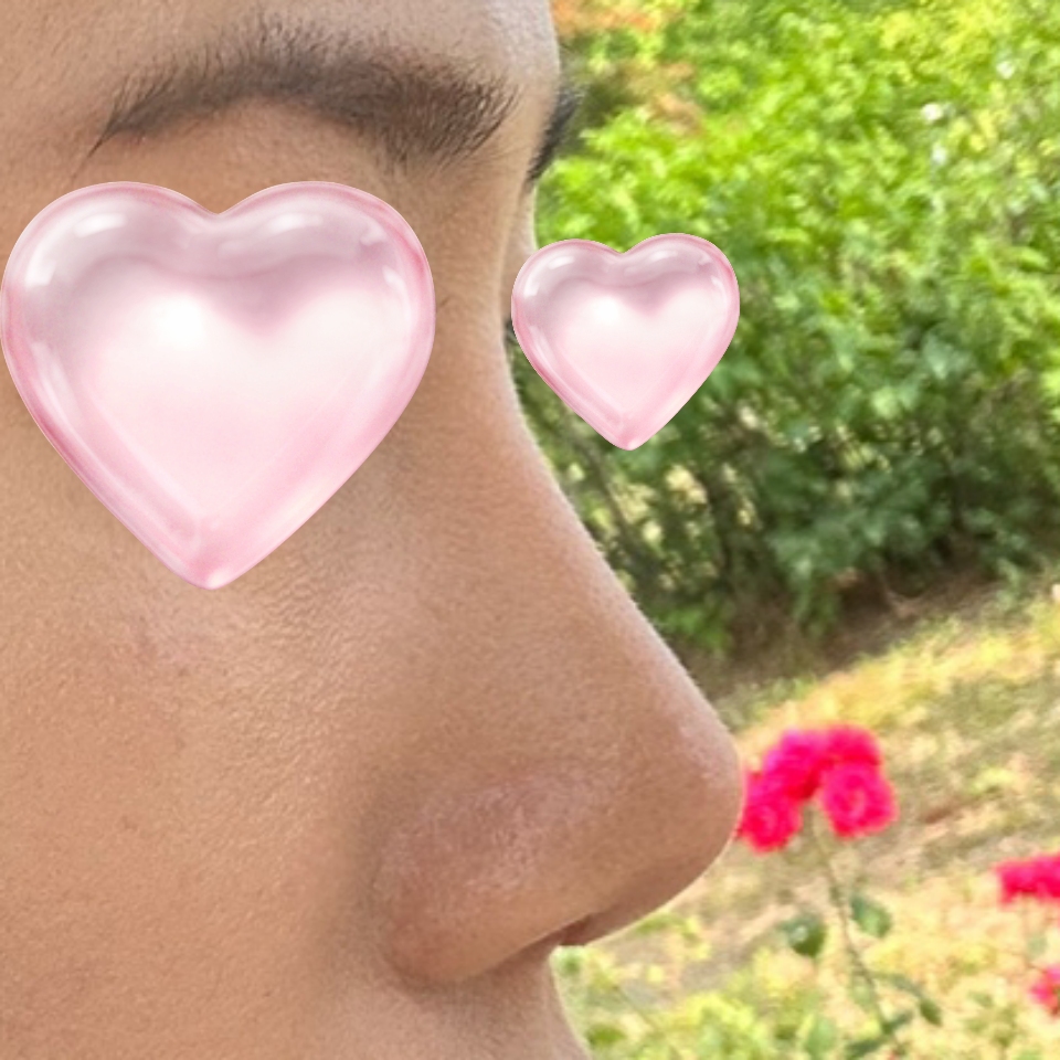 코성형 하길 잘했습니다 !