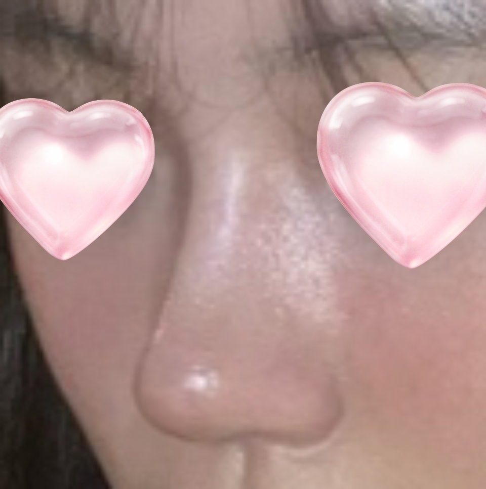 코수술 덕에 인상도 바뀌고 기뻐요 !