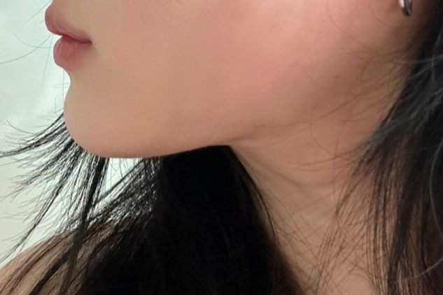 이중턱 지방흡입 후 자존감이 많이 높아졌어요 !