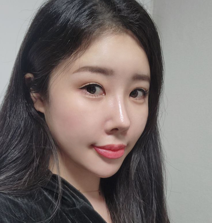 바이브 유원장님께 수술받은지 3달차! 2번째후기