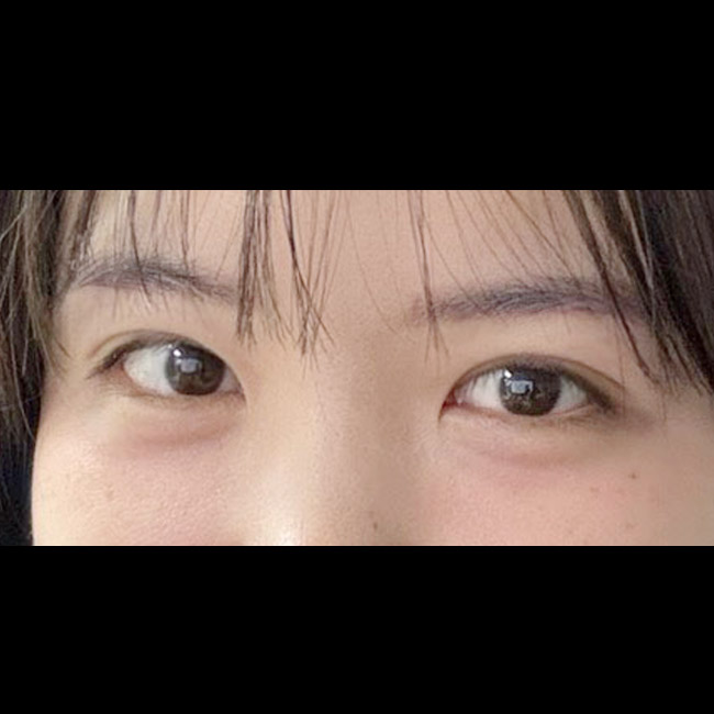 비절개눈매교정 재수술 만족스러워요!