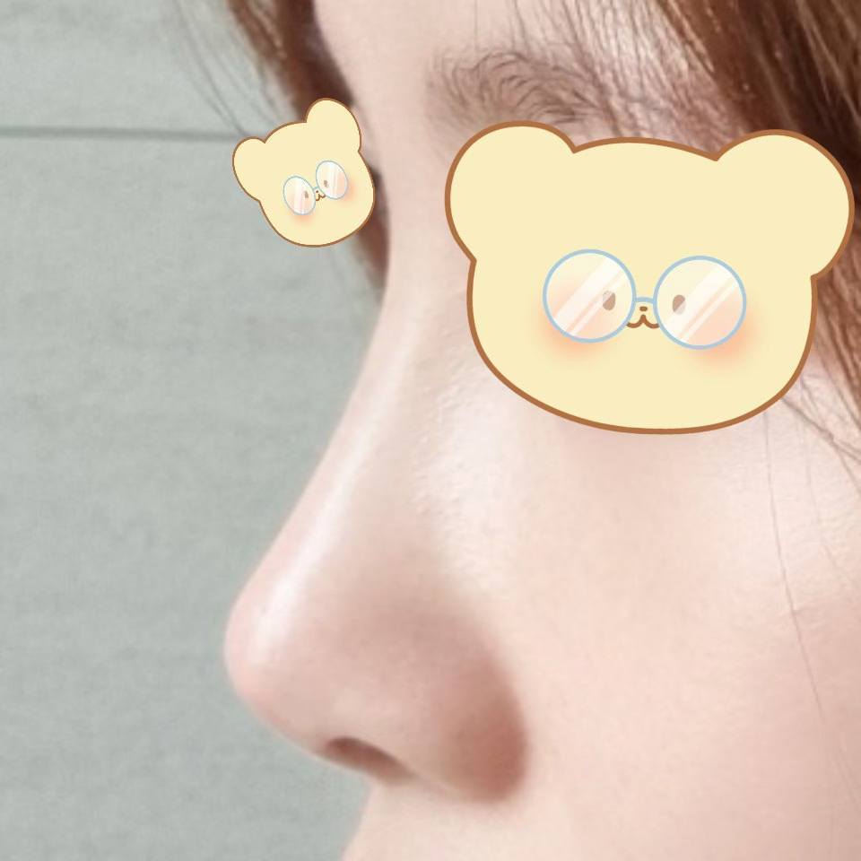 수술 후 이제 사진 보정 안해요 !!