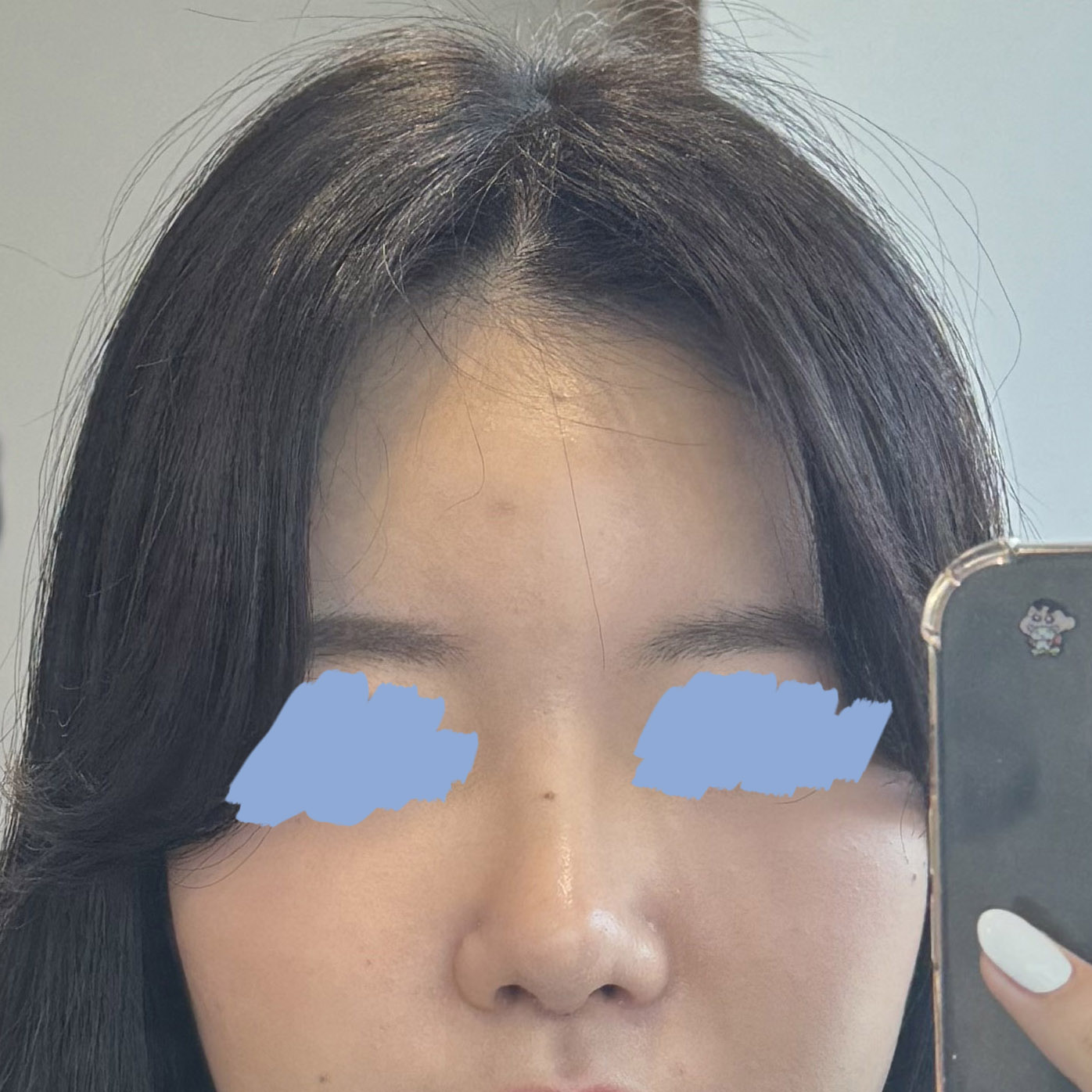 코수술 대만족 후기!