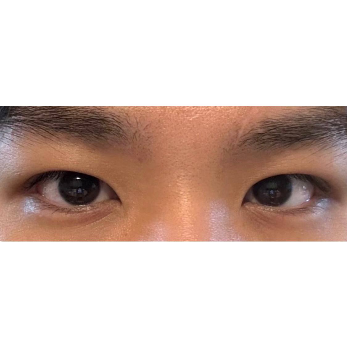 눈 수술 후 만족하며 지내는 중입니다!