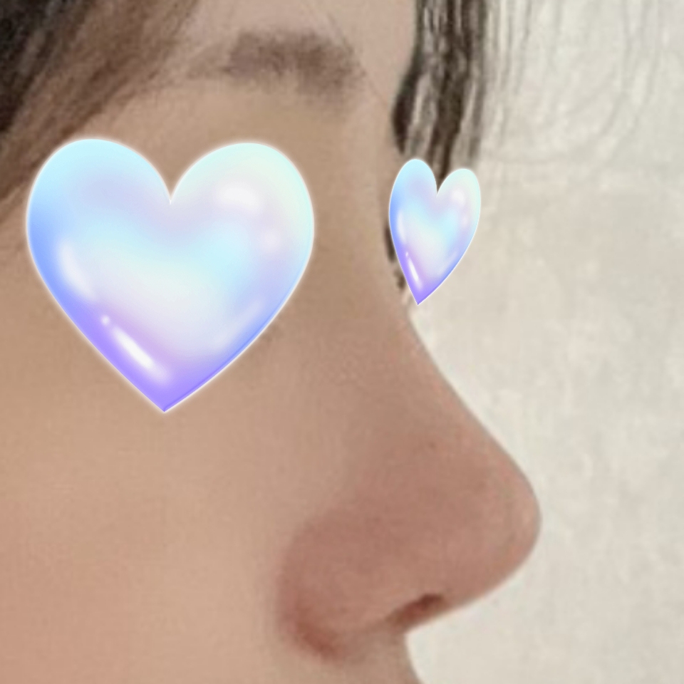 낮았던 코가 개선 되어서 기뻐요